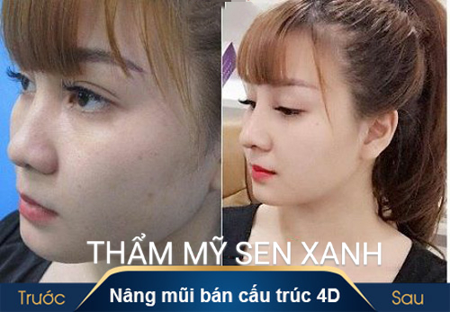 PHẪU THUẬT SỬA MŨI